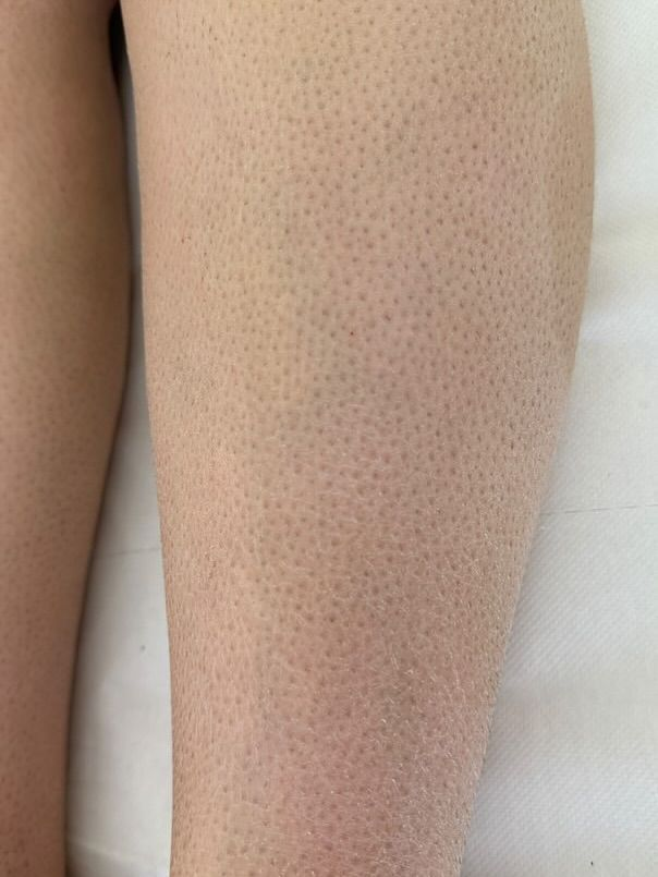 Rối loạn nang lông da khô triệt lông sai cách